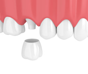 Do porcelain crowns require special care?